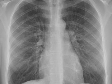 640px-Normal_posteroanterior_(PA)_chest_radiograph_(X-ray)