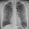 640px-Normal_posteroanterior_(PA)_chest_radiograph_(X-ray)